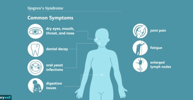 
					Masyarakat Diminta Waspadai Bahaya Sjogren’s Syndrome